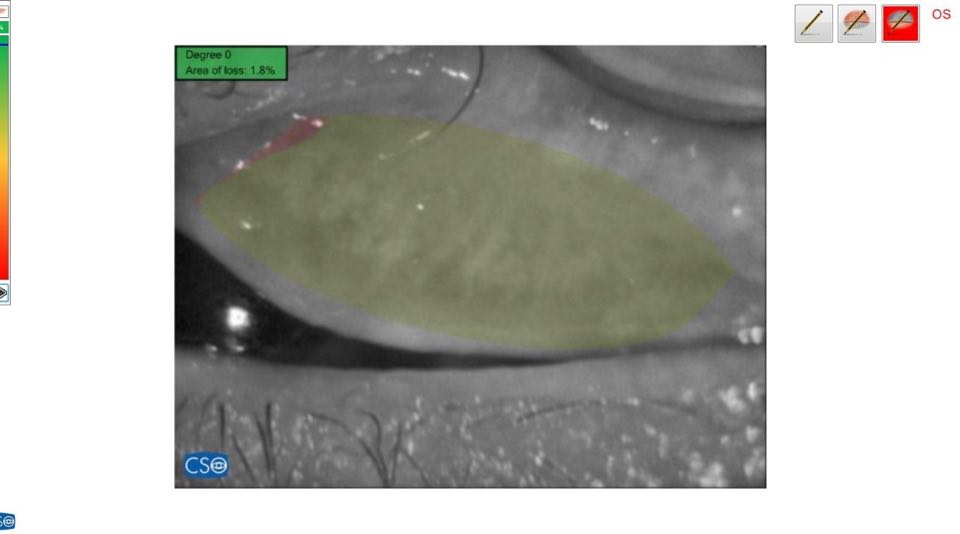 Noncontact Meibography in Patients with Keratoconus